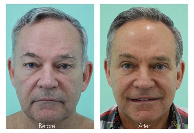 Face Lift Before And After