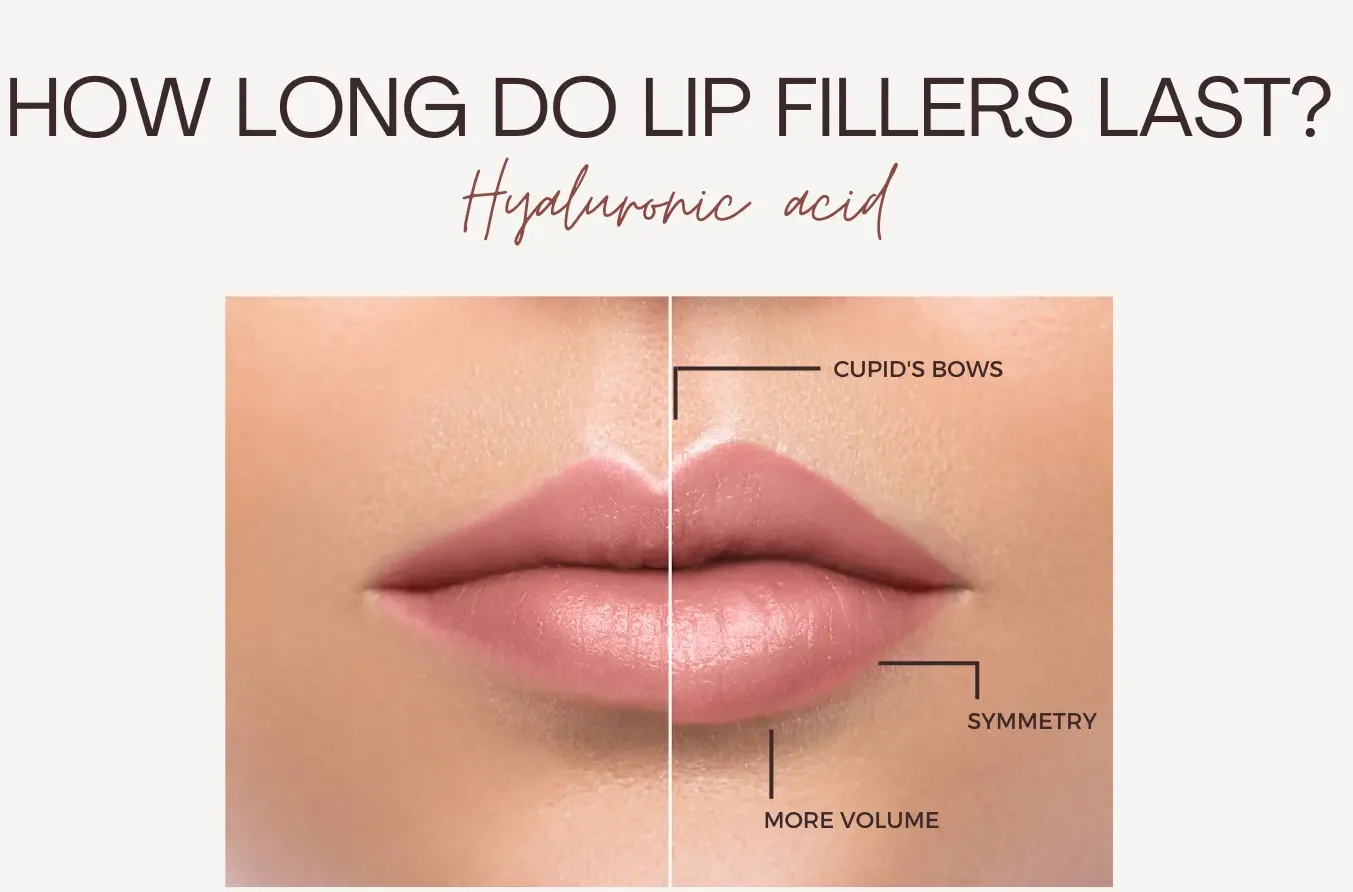 How Long Does Lip Filler Last