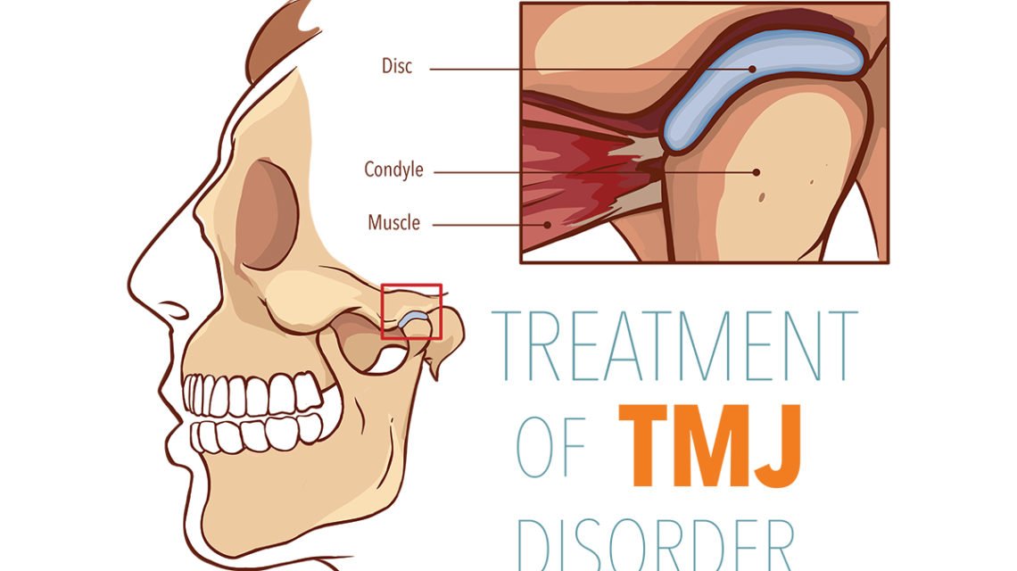 How To Cure Tmj Permanently